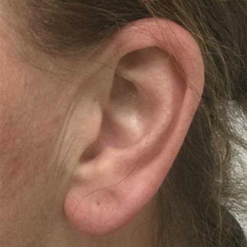 Voor — Oorlel correctie