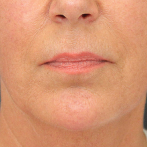 Na — Huidverbetering fillers