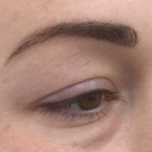 Voor — Onderooglidcorrectie