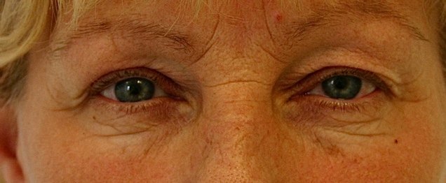 Prachtig natuurlijk resultaat bovenooglid correctie met ook inkorten van de hefspier bij een 51-jarige vrouw.