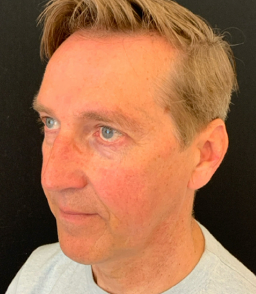 Deep plane voorhoofdslift – voor en na resultaat 4