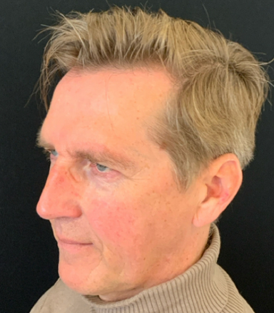 Deep plane voorhoofdslift – voor en na resultaat 2