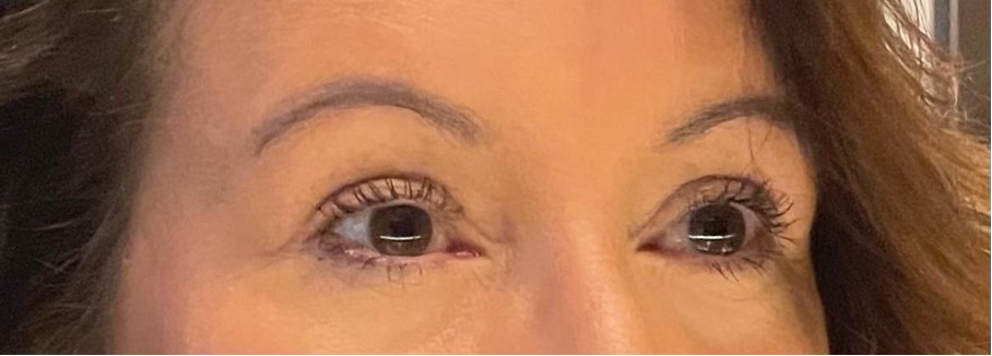 Milanese/Scalpel-shaped ooglidcorrectie