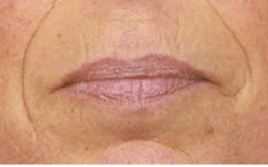 Mondhoeklift zonder operatie: de niet-chirurg