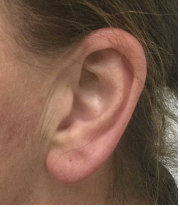 Oorlelcorrectie: alles over oorlel herstel en verjonging - Prof. Aesthetics - Prof. Dr. Berend van der Lei