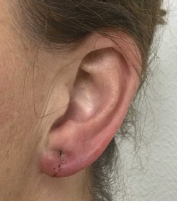 Oorlelcorrectie: alles over oorlel herstel en