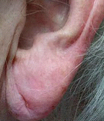 Oorlelcorrectie: verjonging en versteviging van de oorlellen - Prof. Aesthetics - Prof. Dr. Berend van der Lei