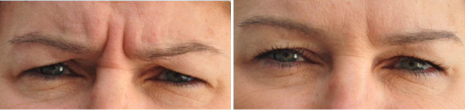 Wat is botuline toxine, oftewel botox? — Prof