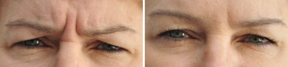 Botuline Toxine (Botox): Wat is het en hoe we