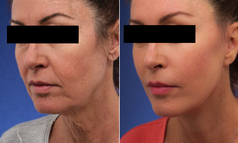 Deep Plane Facelift: de beste facelift die je