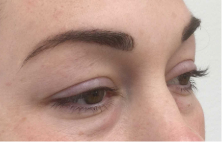 Onderooglidcorrectie: de beste oplossing voor