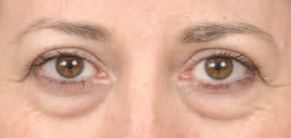 Onderooglidcorrectie: de behandeling tegen wa