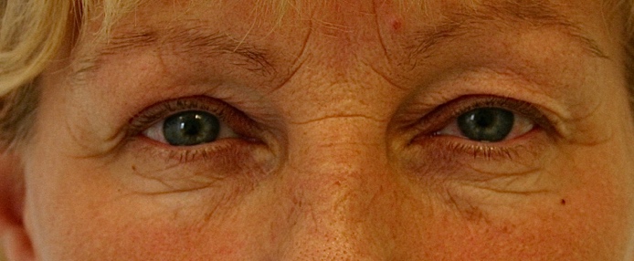 Bovenooglidcorrectie voor – 51-jarige vrouw