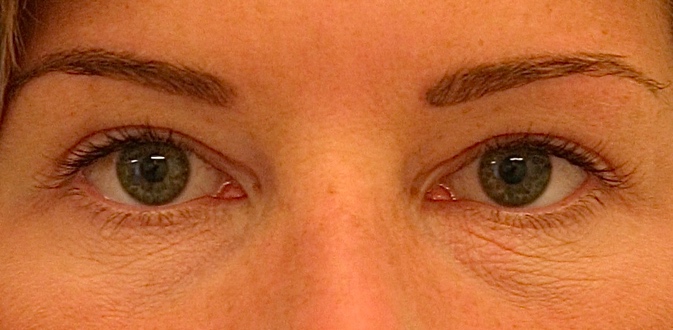 Subtiele bovenooglidcorrectie na – 38-jarige vrouw