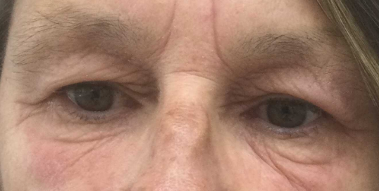 Vragen over een bovenooglidcorrectie — Prof. 