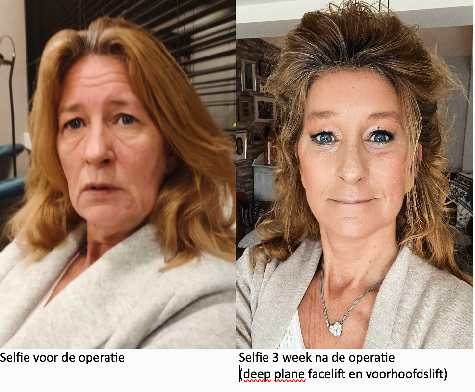 Deep Plane Facelift: de meest natuurlijke en langdurige facelift techniek - Prof. Aesthetics - Prof. Dr. Berend van der Lei