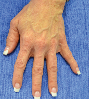 Handverjonging met fillers: herstel van volum