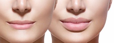 Lipvergroting: meer volume en natuurlijk voll