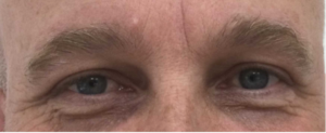 Ooglidcorrectie bij mannen: zo bereik je een natuurlijk mannelijk resultaat - Prof. Aesthetics - Prof. Dr. Berend van der Lei