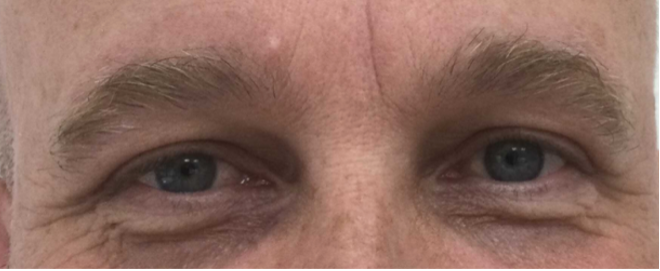 Waarom oogleden zo bepalend zijn voor je uitstraling - Prof. Aesthetics - Prof. Dr. Berend van der Lei