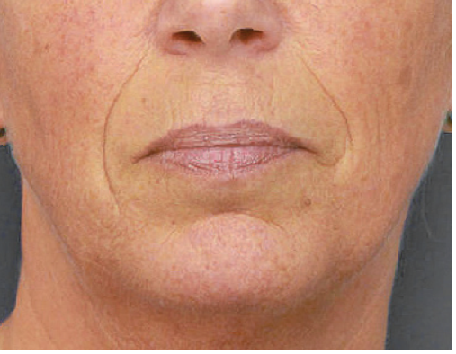 Mondhoeklift: de oplossing voor hangende mond