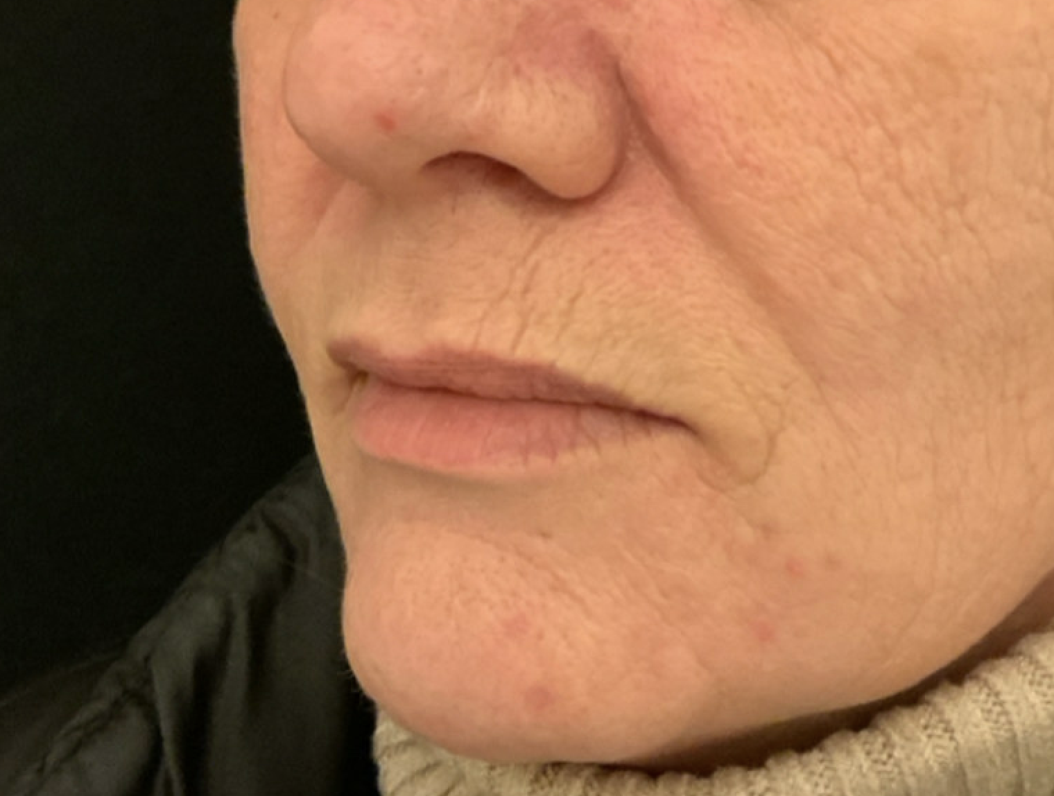 Chirurgische mondhoeklift voor – 52-jarige vrouw