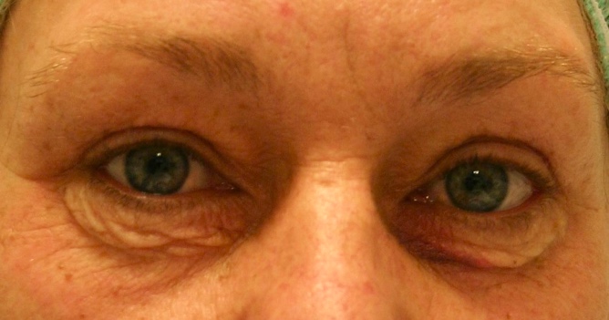 Onderooglidcorrectie voor – 47-jarige vrouw
