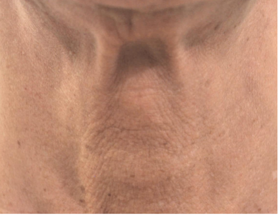 Soorten fillers en hun werking: hyaluronzuur, Profhilo en Radiesse - Prof. Aesthetics - Prof. Dr. Berend van der Lei