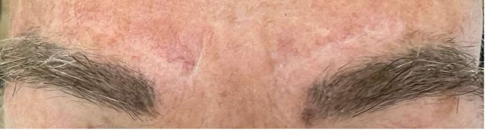 Vragen over de wenkbrauwlift — Prof. Aestheti