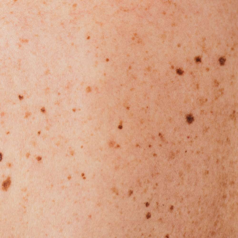 Gelaats-imperfecties