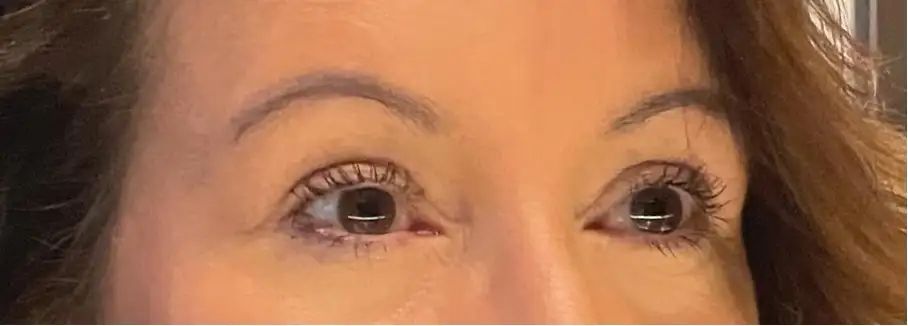Milanese/Scalpel-shaped ooglidcorrectie
